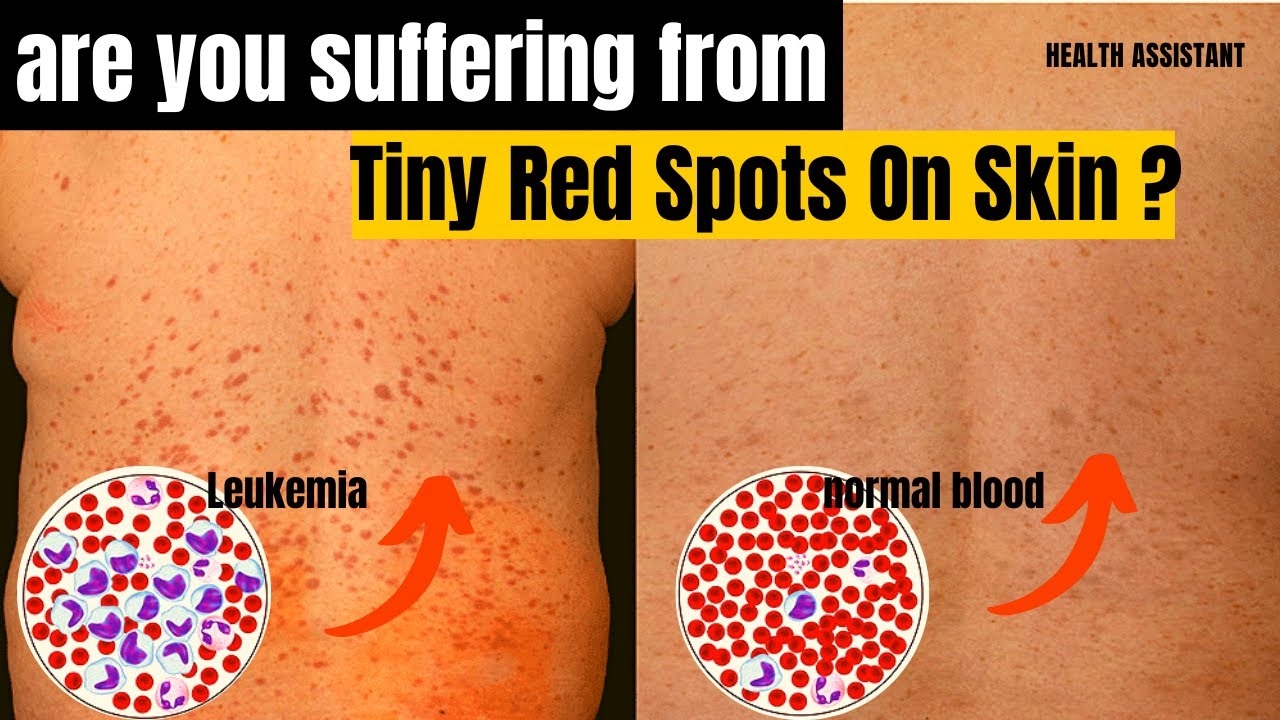 Leukemia Tiny Red Spots On Skin