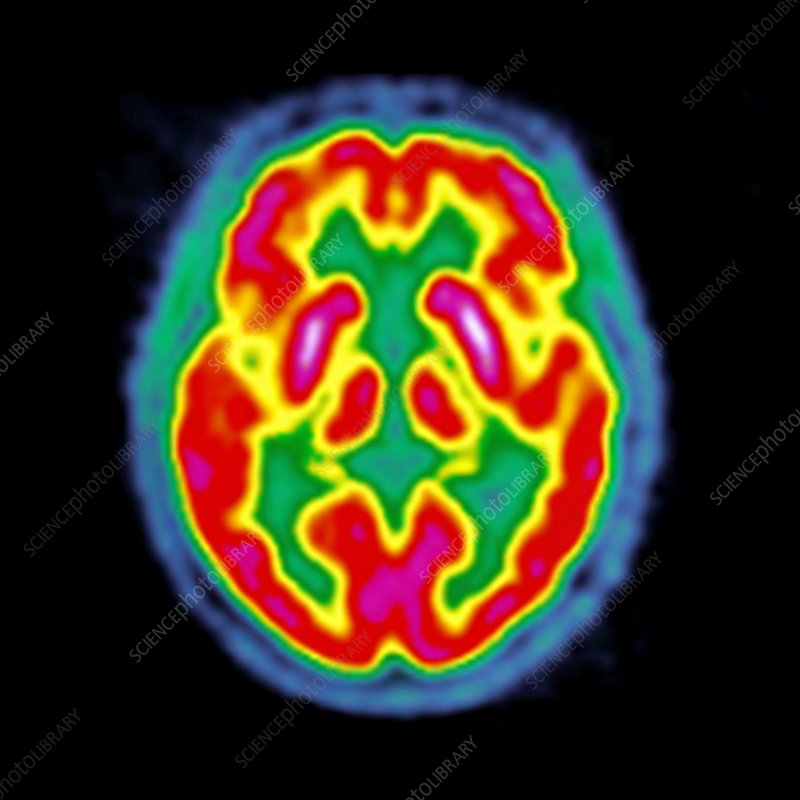 Normal Brain Activity PET Scan Stock Image C026 7610 Science 