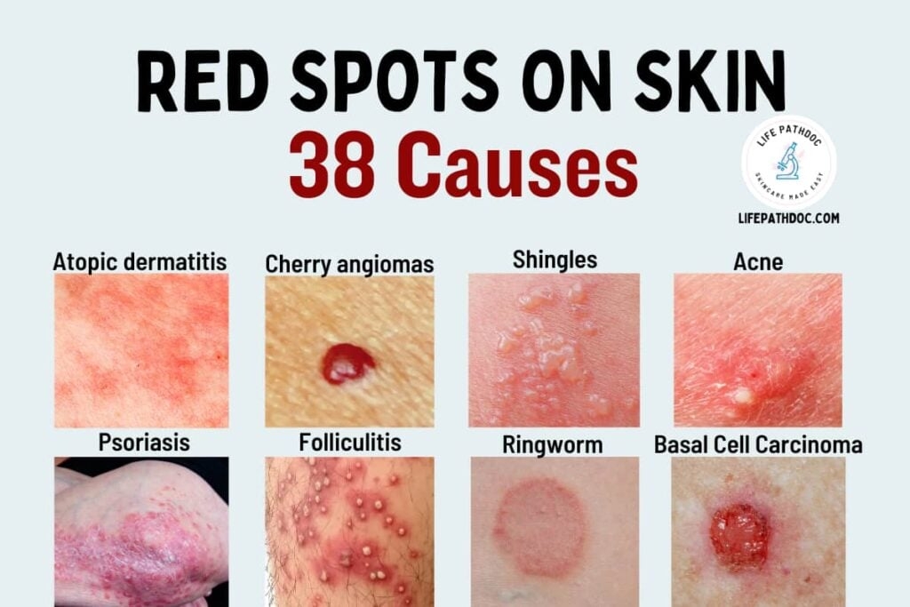 Red Spots On Skin 38 Causes Pictures And Treatment